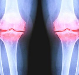 تفاوت آرتریت با آرتروز چیست؟